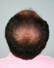 Before Hair Transplant&nbsp;2 Sessions (Areas)